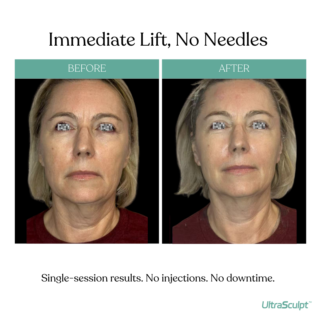 UltraSculpt beforeafters (4) (1)