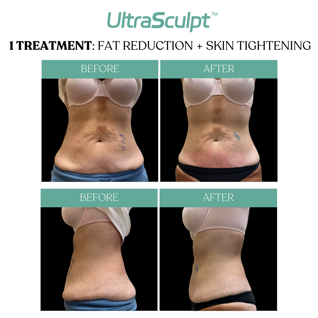 UltraSculpt_ab_beforeafter